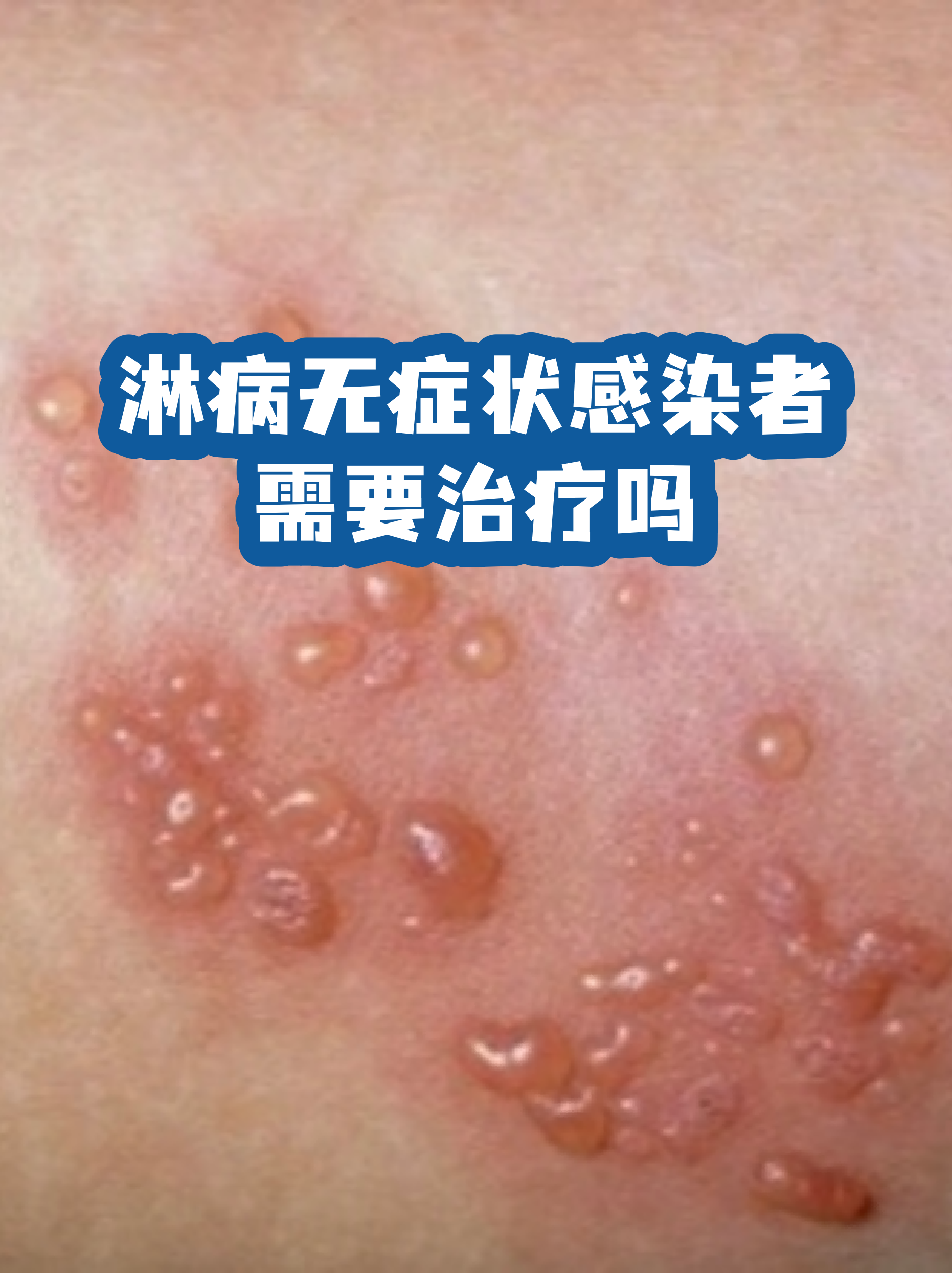 【重庆无症状感染者/重庆无症状感染患者是怎么回事这几天】-第2张图片
