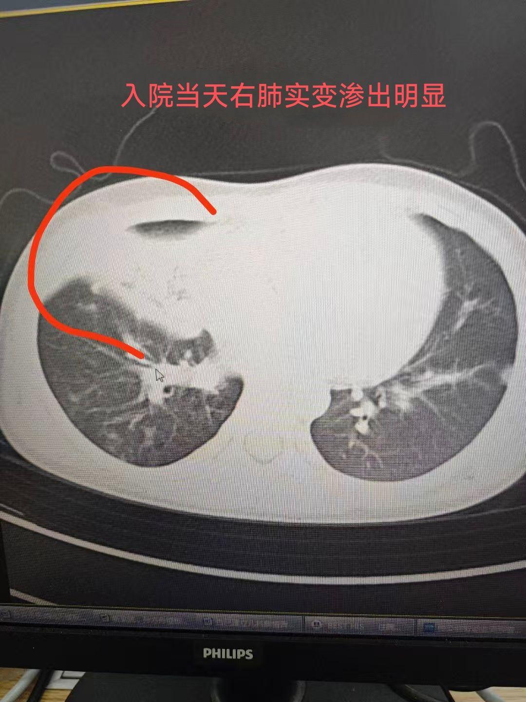 “张家口新型肺炎	” 河北省张家口市新型肺炎？-第2张图片