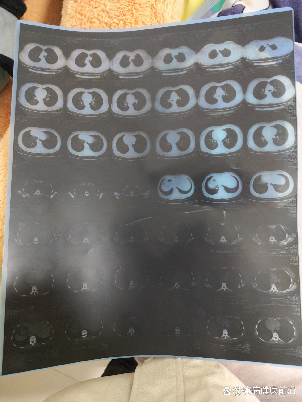 “新型肺炎确诊病例” 新型病毒确诊病例？-第2张图片